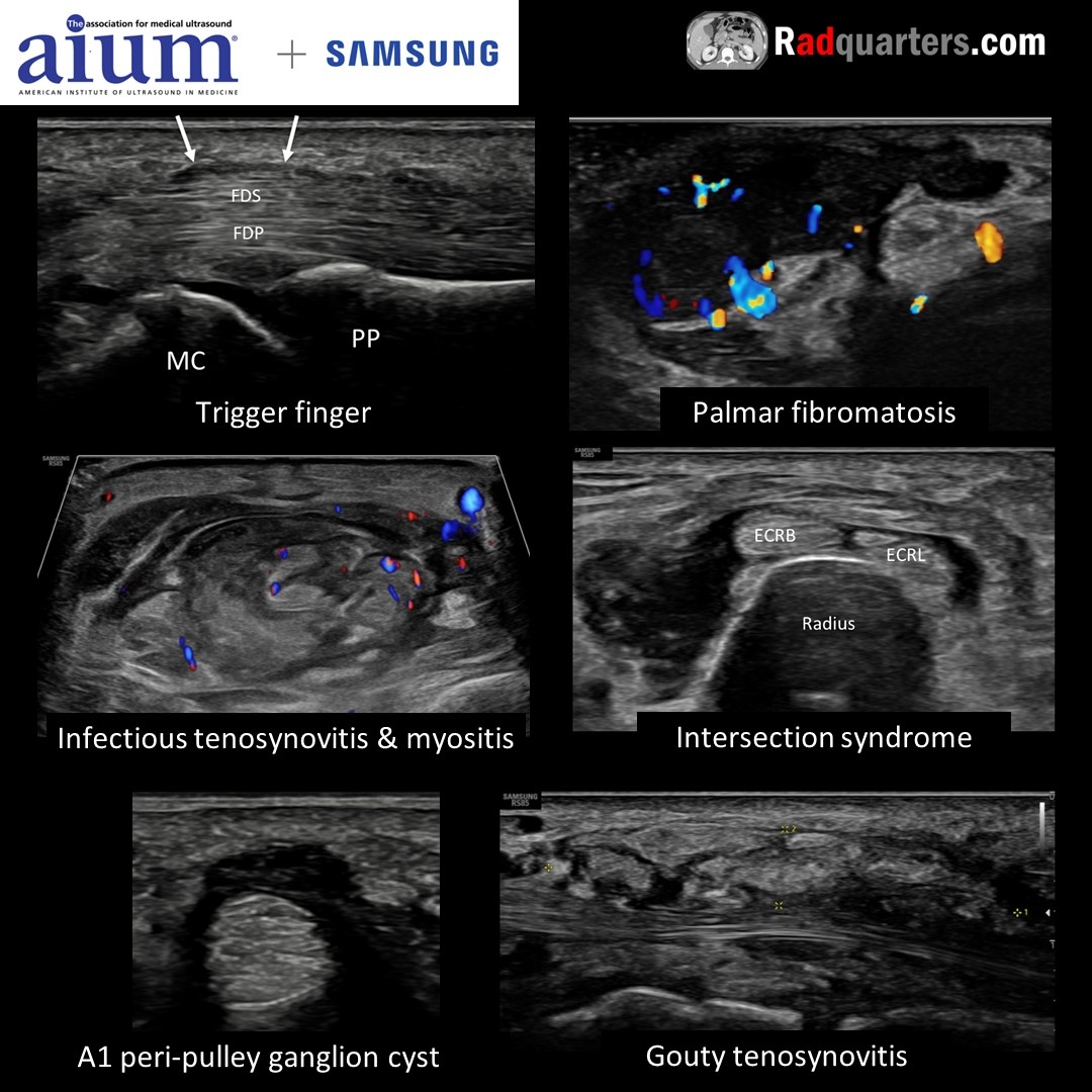Join me for “Ultrasound of the Hand & Wrist: What the Surgeon Wants to Know,” a FREE webinar Wed,11/8/2023 at 1 PM EST hosted by the AIUM in conjunction w/ Samsung. Register here: bit.ly/wristwebinar, or go to aium.org. @BostonImaging @AIUMultrasound #mskrad