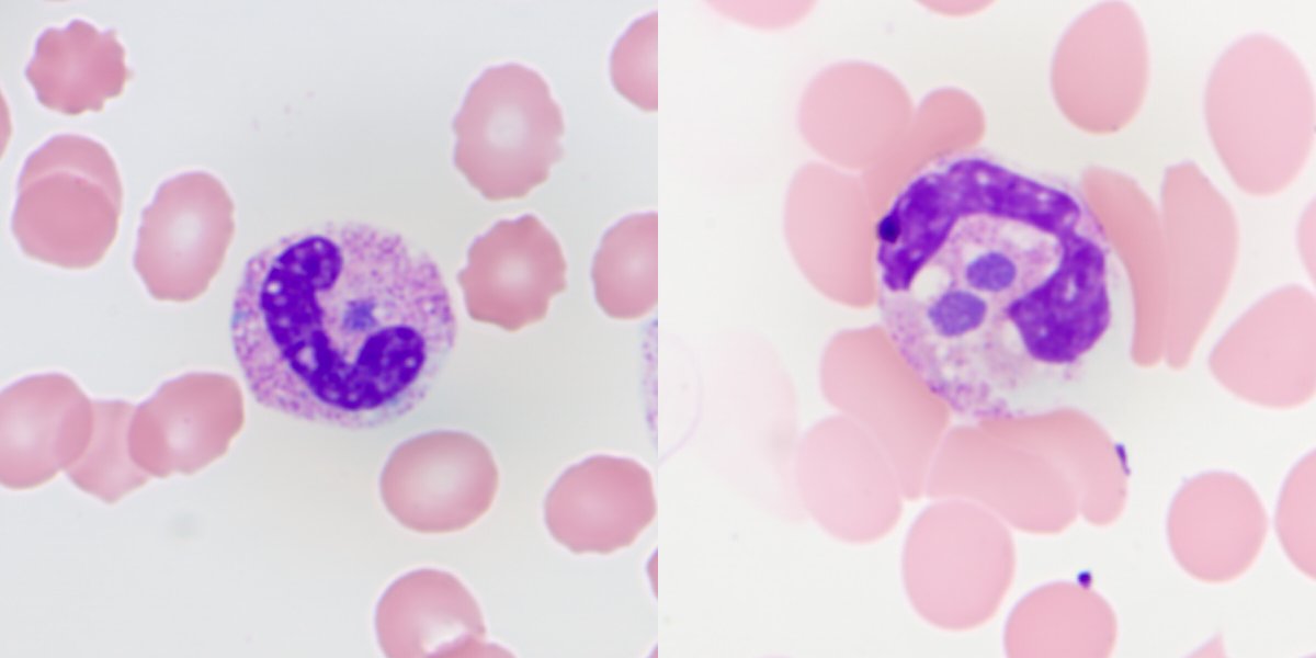 The Brief Case: A febrile illness from a pesky passenger from Upstate New York tinyurl.com/ycy4byab 79 yo M with weakness, fevers and mental status changes Peripheral blood film shown. Serology negative, PCR positive for the pathogen @ASMicrobiology
