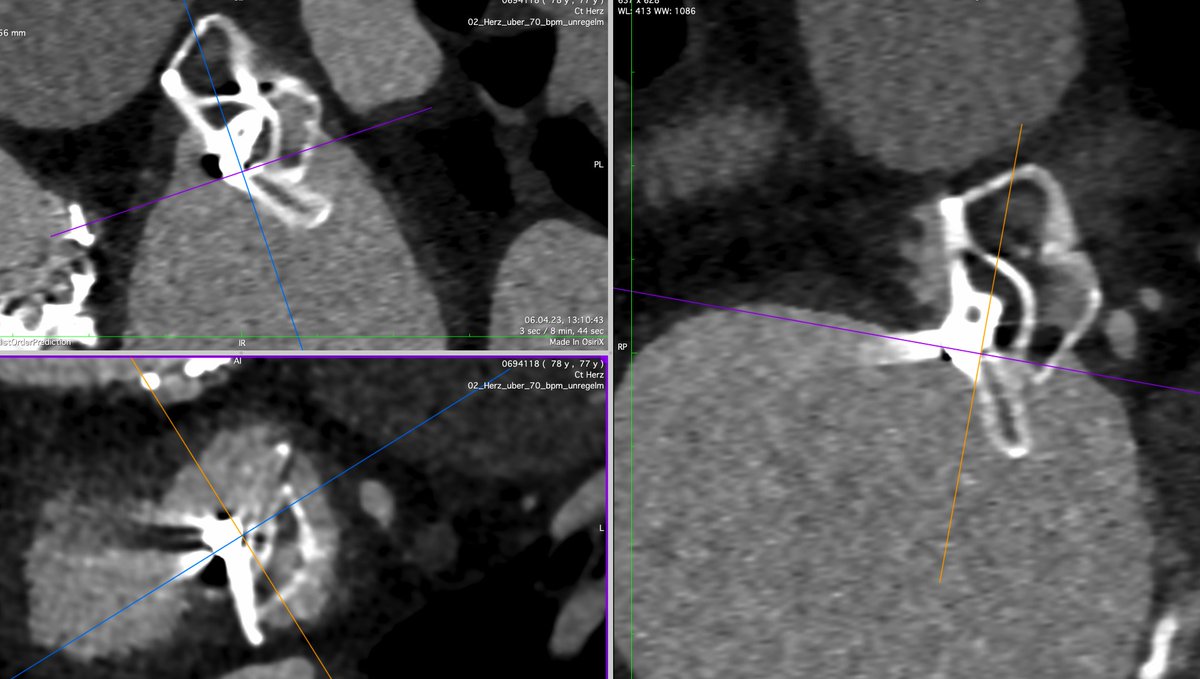 CSIcongress's tweet photo. Don't miss this exciting live case with Dr. Horst Sievert at CSI Focus LAA: Tilted LAA occluder with residual leak: Should it be closed and can it be closed?
When: Final session on Saturday, November 11th
Register today for CSI Focus LAA: https://t.co/PEqyv0J5Zs
#CSIFocusLAA #LAA #CSILAA #LAAclosure
