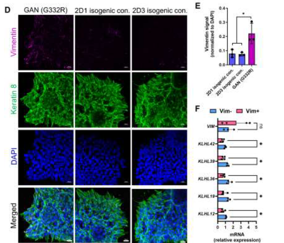 American Society for Cell Biology (@ascbiology) on Twitter photo Giant Axonal Neuropathy (GAN) arises from mutations in gigaxonin, an E3 ubiquitin ligase adaptor.
New work from Battaglia et al. (<a href="/OfGlia/">BattleOfTheGlia</a>) shows intermediate filament accumulation in novel iPSC-derived astrocyte & brain organoid models of GAN.
molbiolcell.org/doi/10.1091/mb… Giant Axonal Neuropathy (GAN) arises from mutations in gigaxonin, an E3 ubiquitin ligase adaptor.
New work from Battaglia et al. (<a href="/OfGlia/">BattleOfTheGlia</a>) shows intermediate filament accumulation in novel iPSC-derived astrocyte & brain organoid models of GAN.
molbiolcell.org/doi/10.1091/mb…