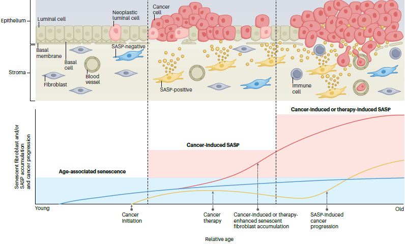 Christopher Heaphy (@chris_heaphy) on Twitter photo So excited to share our latest article in <a href="/NatRevUrol/">Nature Reviews Urology</a> on the prognostic and therapeutic potential of senescent stromal fibroblasts in prostate cancer led by <a href="/JoakinMori/">Joakin MORI</a> #senescence #ProstateCancer #telomeres <a href="/The_BMC/">Boston Medical Center</a> <a href="/BUMedicine/">Boston U Chobanian & Avedisian School of Medicine</a> <a href="/hopkinskimmel/">Johns Hopkins Kimmel Cancer Center</a>
rdcu.be/dpWKI So excited to share our latest article in <a href="/NatRevUrol/">Nature Reviews Urology</a> on the prognostic and therapeutic potential of senescent stromal fibroblasts in prostate cancer led by <a href="/JoakinMori/">Joakin MORI</a> #senescence #ProstateCancer #telomeres <a href="/The_BMC/">Boston Medical Center</a> <a href="/BUMedicine/">Boston U Chobanian & Avedisian School of Medicine</a> <a href="/hopkinskimmel/">Johns Hopkins Kimmel Cancer Center</a>
rdcu.be/dpWKI