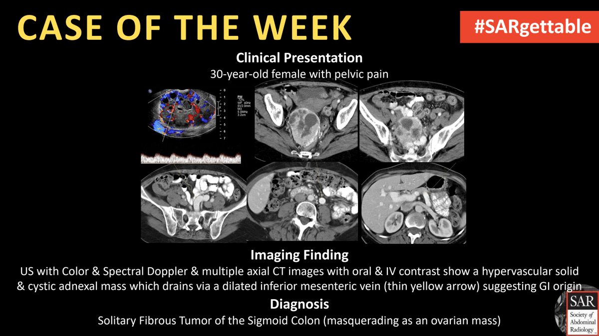 The answer to last week's #SARgettable Case of the Week, submitted by @kchang, is: Solitary Fibrous Tumor of the Sigmoid Colon (masquerading as an ovarian mass). Thanks for playing! @SARDFPRECTAL