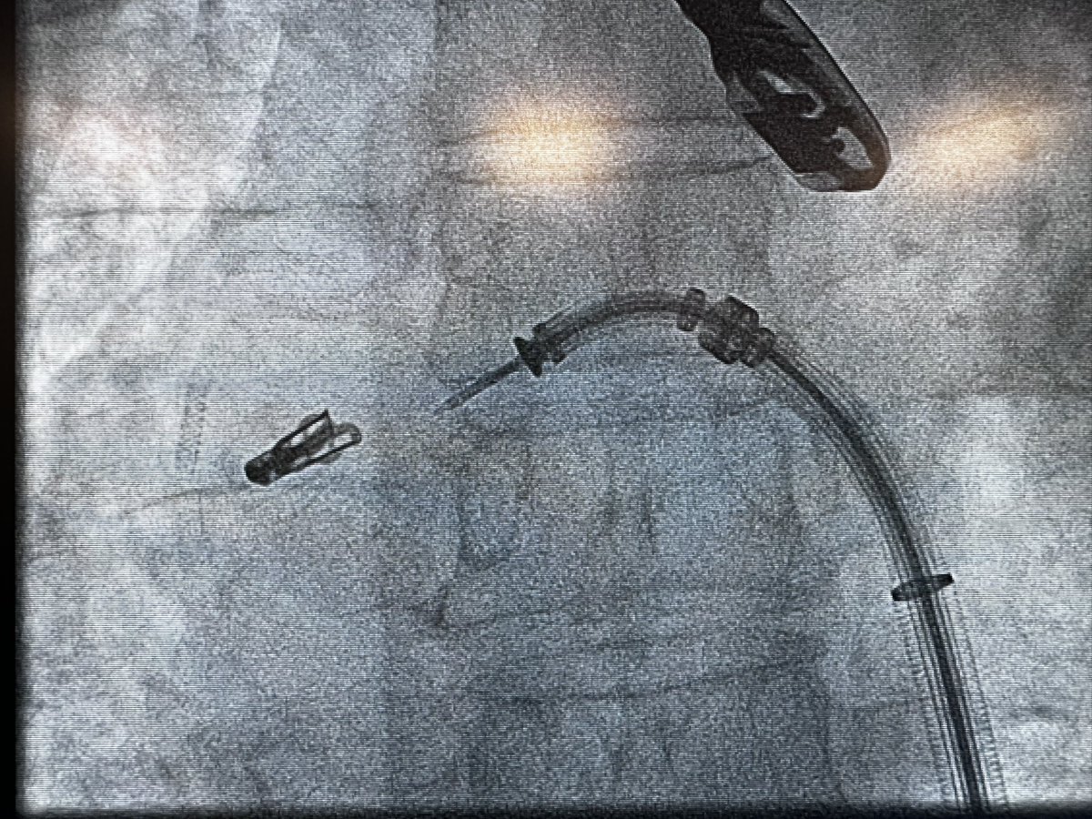 HolgerNef's tweet photo. When left is right…#situsinversus #mitraclip #justflipit
➡️successful mitral repair in a patient with dextrocardia
@bwu74
@KardiologieHH
@dscharpfMD
@MarcVorpahl https://t.co/UrsV28QE4j