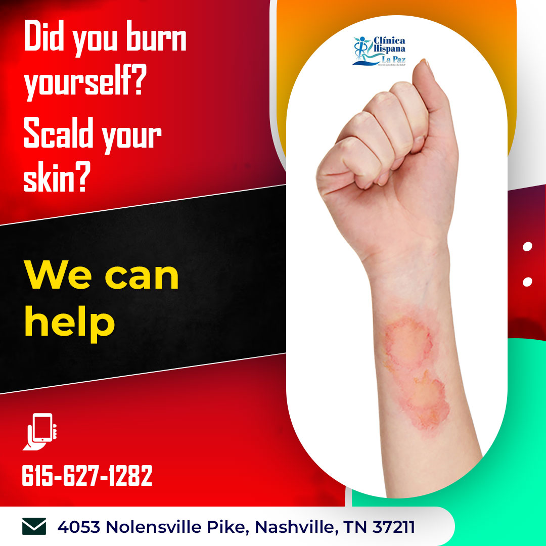 Hot liquids, stoves and drinks can all be hazards to your skin.  If you burned yourself, let Clinica Hispana La Paz take a look.  Some burns are more serious than others and if left untreated can result in an infection. Visit Clinica Hispana La Paz today. 615-627-1282
#BurnInjury