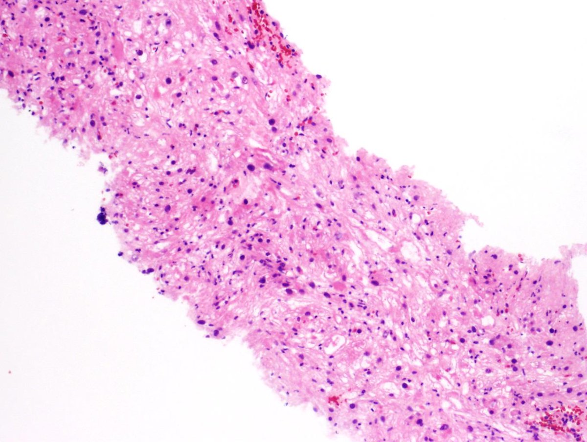 A treat of a case after this hallowed day!

48 yo female with liver lesion, which is immunopositive for HMB45 and SMA. There is patchy staining for CD68 & TFE3 in scattered cells, and nonreactivity for SOX10, DOG1, AE1/AE3, ERG and arginase. 

Full case: ipa-na.org/COM/10-2023