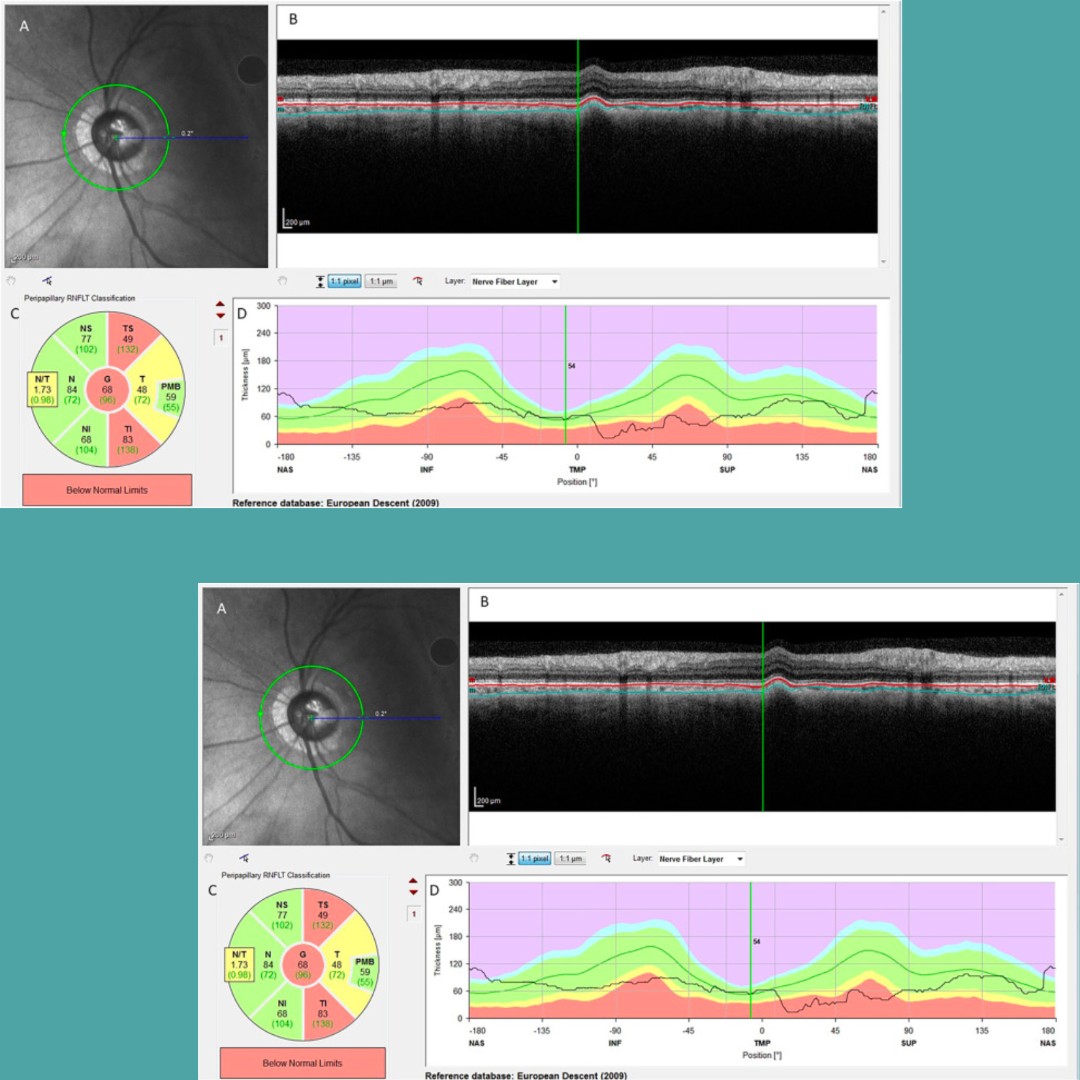Vascular Parkinsonism (VP) is characterized by rigidity and bradykinesia, predominantly affecting lower limbs. Optical Coherence Tomography (OCT) facilitates visualization of the retina and choroid. 

🧵(1/2)