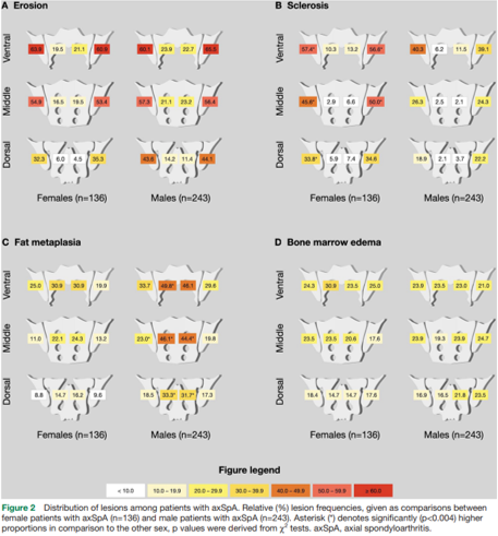 eular_ARD's tweet photo. 🚻 Sex-specific #imaging in #axSpA: one size does NOT fit all❗ 

♂️ more #ankylosis &amp; #fatmetaplasia
♀️ more #sclerosis
↔️ active #inflammatory lesions comparable in both sexes

⚠️ risk of false ➕ ves in 🚺

🔗 https://t.co/o3Ezp5oD9Z

@ProftDr @mprotopopov https://t.co/gLs1oqpmdF