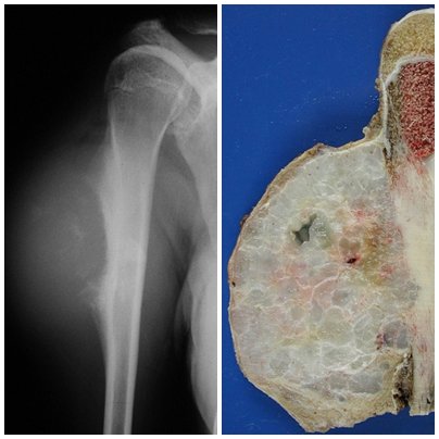 IhabFathiSulima's tweet image. What is the bone pathology ?