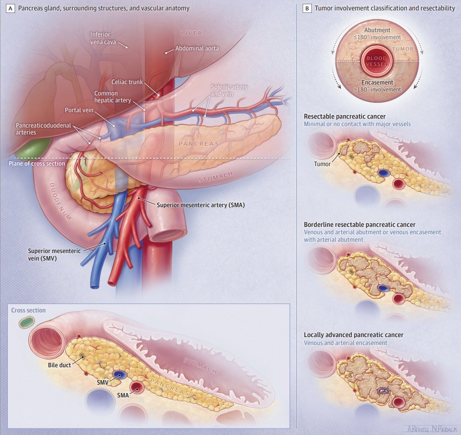Superb graphic 👇 from a @JAMA_current review on pancreatic cancer visualizing the peripancreatic vessels vis a vis operable vs. borderline resectable vs. locally advanced

As a non-surgeon I will be saving this for my discussions with patients  #pancsm 

pubmed.ncbi.nlm.nih.gov/34547082/