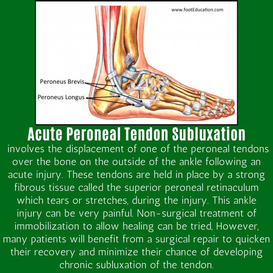 #AcutePeronealTendonSubluxation 
buff.ly/3M1YkE0 
#patienteducation #FootEducation #OrthoEducation #MedEd #education #4patients #peerreviewed #footandankle #orthopaedics #orthopedicsurgery #footfacts #anatomy #ankle #foot #healthyfeet