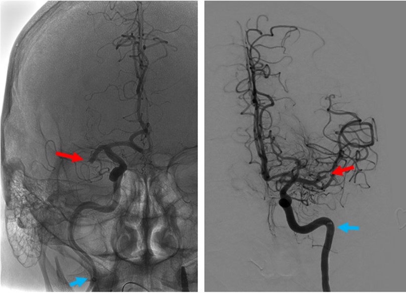 mtbendermd's tweet photo. In super-bore era, is radial EVT a goal? With right guide (@Balt_Group Ballast, 🙏 @PascalJabbourMD) right case (M1/M2, NOT ICA-T, laterality no matter), I'm ascending slope of enlightenment. Consecutive cases, TICI3 FPE w 071 aspiration. 😉@gartner_inc hype cycle https://t.co/6Fiit90UeL