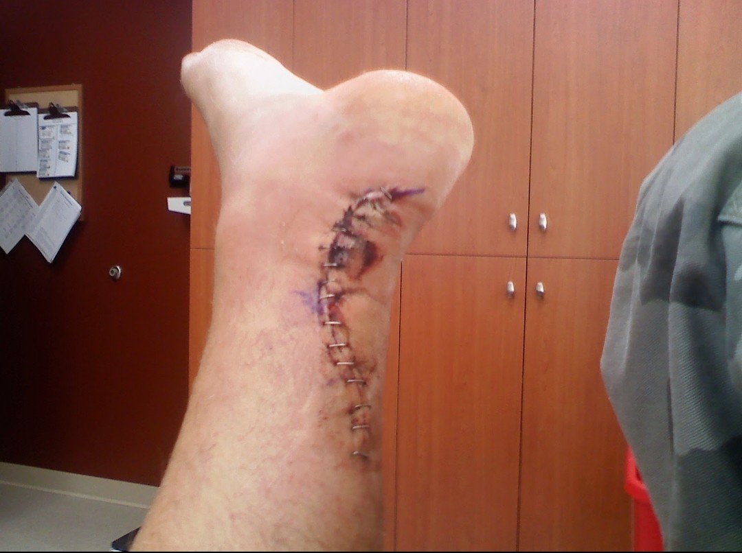 abatte's tweet photo. @KirkCousins8 I had that same surgery after a softball game. Good luck in recovery! It's no fun! https://t.co/fdZI5VzgHc
