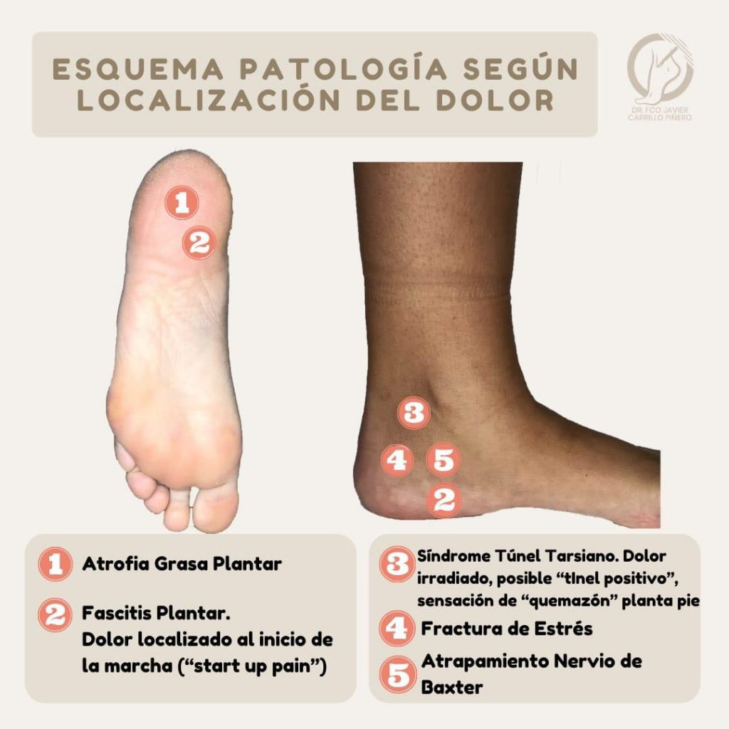 FisioWebinar's tweet photo. ¿Síndrome de la almohadilla grasa del talón o Fasciopatía plantar? 🦶🏼 

El dolor plantar del talón es la afección musculoesquelética más frecuente del pie y es responsable de más de un millón de consultas externas al año.

📸 @DrfjCarrillo 

🧶 https://t.co/YKDcqUtRiu