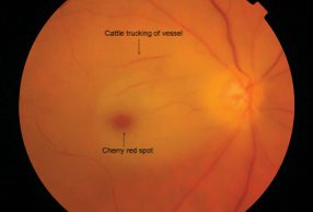 Which Disease affect children associated with cherry red spot ?