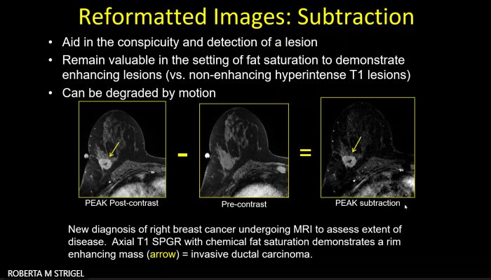 Breast Imaging Fellowship Consortium (@breastradfellow) on Twitter photo Insightful lecture by Dr. Roberta Strigel at <a href="/UWiscRadiology/">UW Radiology</a> on Breast MRI Artifacts and How to Improve. 🔍
Â
Sharing some key takeaways/slides from this informative session! #BreastMRI #Radiology Insightful lecture by Dr. Roberta Strigel at <a href="/UWiscRadiology/">UW Radiology</a> on Breast MRI Artifacts and How to Improve. 🔍
Â
Sharing some key takeaways/slides from this informative session! #BreastMRI #Radiology