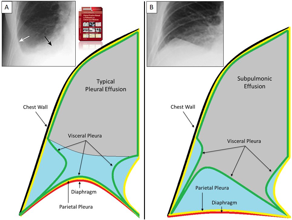 Subpulmonic Effusion #RockofGibraltar sign
Effusion appears mod on CT scan but small on upright U/S & x-ray, often read as elevated hemi diaphragm, decub key
#hospitalist #emergencymedicine #chestradiology #MedTwitter #pulmonary #internalmedicine #criticalcare  #meded #radiology