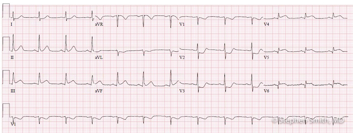 STEMI or No STEMI? Join us Live at 5pm PST tonight bit.ly/3slEqNy as @amalmattu is our guest at EM:RAP Grand Rounds for an ECG review segment. #meded #ECG #amalmattu #STEMI #FOAMed What you think about this ECG? Reply below! 1) No STEMI 2) STEMI