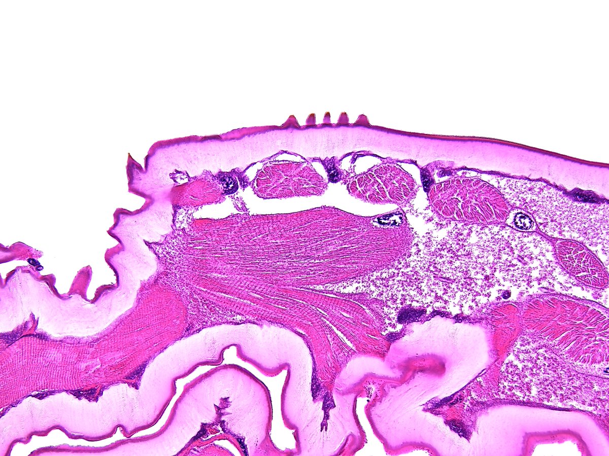Myiasis (larva body). #Pathology #Pathologist #Parasite
