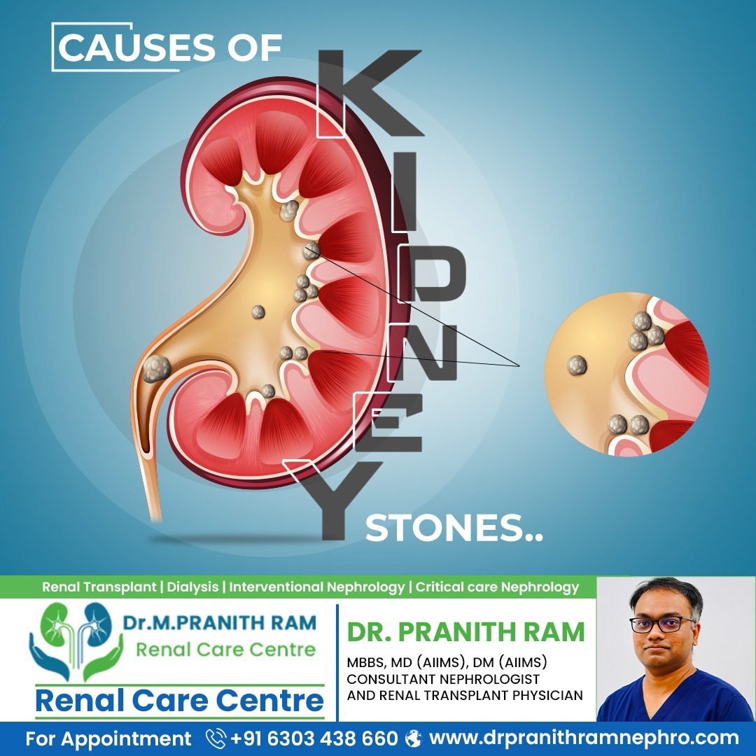 DrPranithram's tweet photo. Kidney stones form due to concentrated urine, excessive calcium, oxalates, uric acid, and dehydration. 

consult Dr Pranith ram +91 6303438660 or visit our website : https://t.co/HXn9VkUUxk

#kidney #kidneyhealth #kidneystones #drpranithramnephrologist https://t.co/Q9abhidrfC