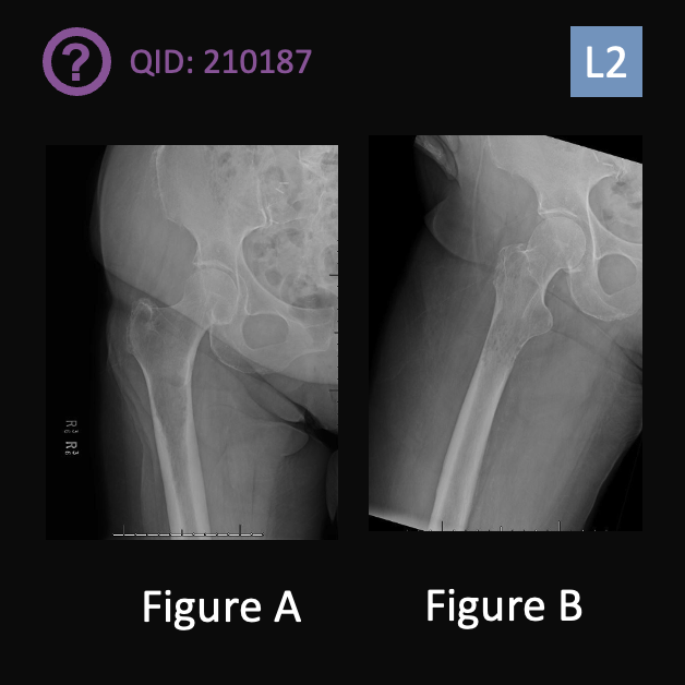 orthobullets's tweet photo. Can you answer this daily question from our Free QBank correctly?
QID: 210187
Comment your answer below, then check to see if you got it correct by clicking the link below to see the answer & explanation.
https://t.co/evWJ1IXy2u
#orthotwitter #MedTwitter https://t.co/qcU3vXDwEq