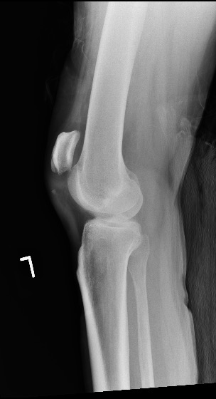 orthotraumamd's tweet photo. 54 y/o M with knee swelling and unable to do a straight leg raise after a fall. See anything? What's your next step?
MRI? CT?
Operative vs nonoperative. #orthotwitter #MedTwitter #medicalstudents #MedEd #orthobullets https://t.co/ISmwKjNbwp