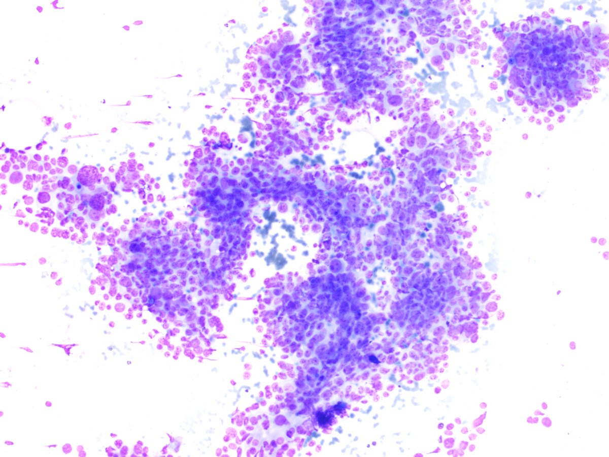 A middle aged female with h/o MRM rt breast 3 yrs back followed by CT & RT, now FNAC from lt breast, comments please #pathology #cytopath #breastcancer #pathresidents #PathTwitter #pathologists