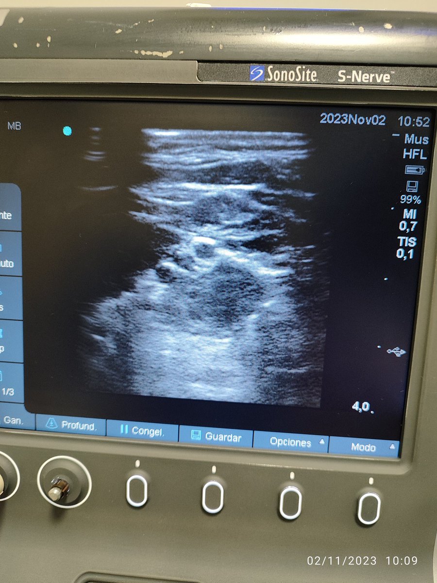 Javier Valiente (@lourtauj) on Twitter photo Colocación de catéter interescalénico para #AnalgesiaPosoperatoria e inicio precoz de Rehabilitación en paciente con bloqueo postraumático de codo, por <a href="/linkinbach/">Dr. Cafeína</a> #AnestesiaRegional #MIR <a href="/AyRHUVM/">Anestesiología y Reanimación HUVM</a> #COTeam Colocación de catéter interescalénico para #AnalgesiaPosoperatoria e inicio precoz de Rehabilitación en paciente con bloqueo postraumático de codo, por <a href="/linkinbach/">Dr. Cafeína</a> #AnestesiaRegional #MIR <a href="/AyRHUVM/">Anestesiología y Reanimación HUVM</a> #COTeam