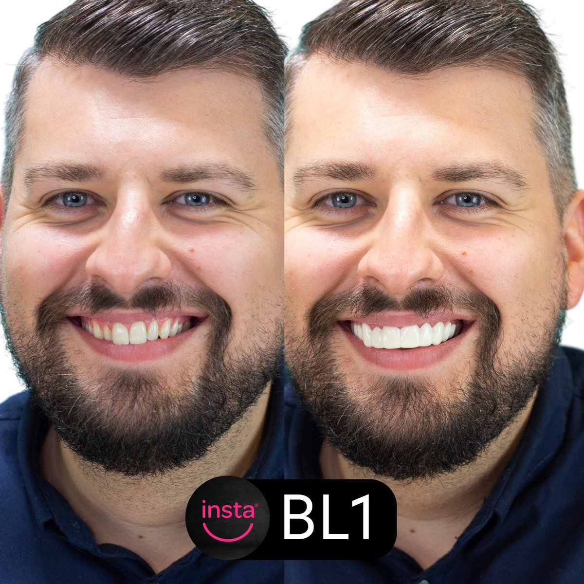 instasmile's tweet image. Take a look at Craig's sparkling BL1 Hollywood Smile! Our brightest white shade isn't for everyone, but we're sure you'll agree Craig pulls it off perfectly! Would you choose our BL1 clip-on veneers? ✨