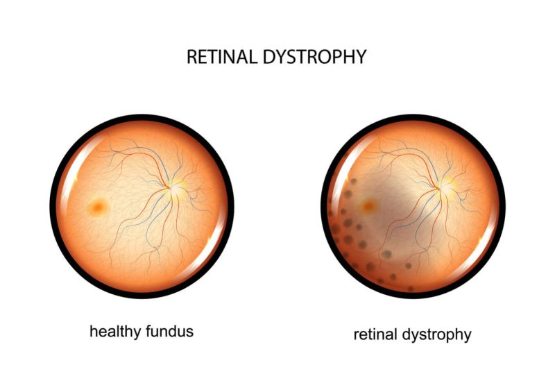 Retinal dystrophy refers to a group of inherited eye disorders characterized by the progressive degeneration of the retina, the light-sensitive tissue located at the back of the eye.

Visit us: lnkd.in/drMgeUAW
#eyeinfection #ophthalmology #retinaldystrophy