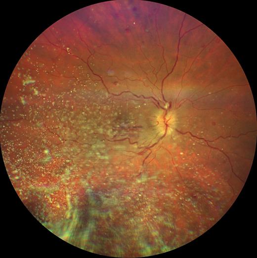 OphthaKarger's tweet photo. Bilateral Optic Disc Swelling with Persistent #Visual Loss in Anemia: Case Report
โก๏ธ https://t.co/xT4v6lCf6G
โ๏ธ Van Langenhove K. and Tusscher M.P.
๐ #CaseRepOphthalmol
#OpenAccess https://t.co/RvIiLsSf3j