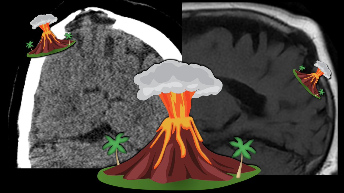 It’s not everyday you get to see the brain explode into its coverings ...
