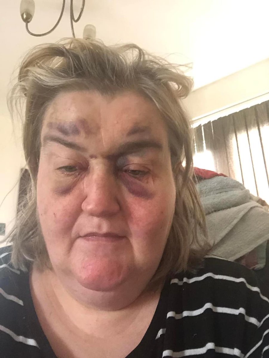 RJProduction3's tweet image. On #AddictionAwarenessWeek I wanted to post today how proud I am of my wife Emma. From nearly dying due to alcohol after losing 5 family members in 3 years, to now being a #Recovery Coach to help others . First pic detox Jan 22, 2nd Oct 2023 #RecoveryPosse 649 days sober today