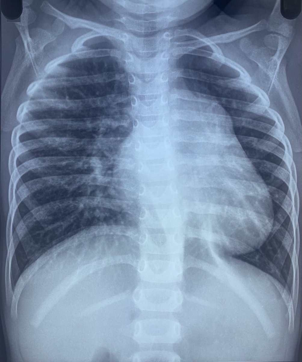 3 yr old child with H/O recurrent resp infection in infancy. Had first echo at the age of 2 years only (by an adult cardiologist) which was reported as normal. Now findings suggestive of severe PH. What lesion might have been missed in the first echo?