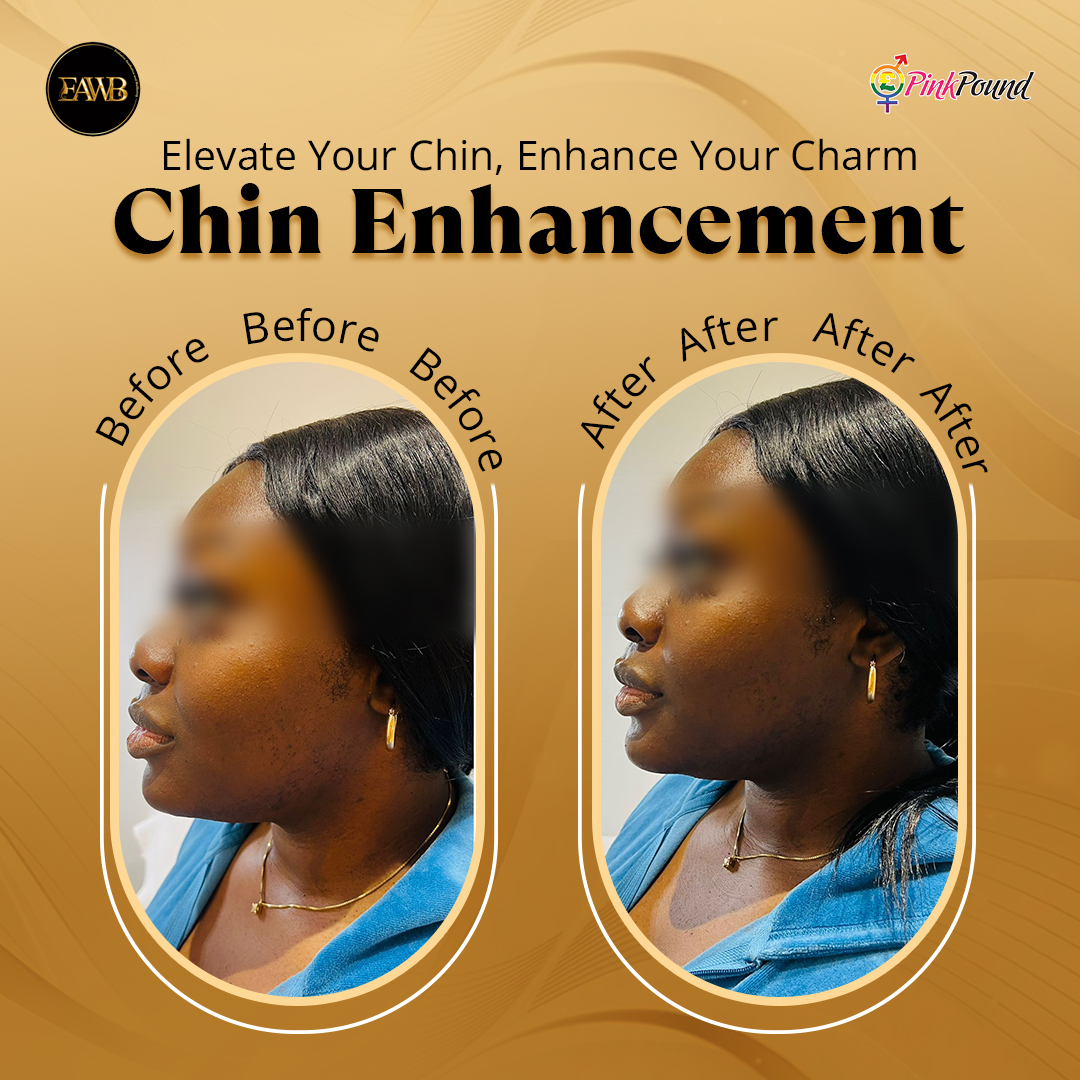 ExclusiveAawb's tweet photo. Your Dream Chin And Smile - Our Expertise
Chin Enhancement And Nasolabial Fold Treatments Are All You Need

Enhance Your Natural Looks, Reveal Your Radiant Smile With Us

Schedule Your Appointment Today
#chinenhancement #nasolabialfolds #treatment #beautycare #naturallooks https://t.co/PHZnJpCbsL