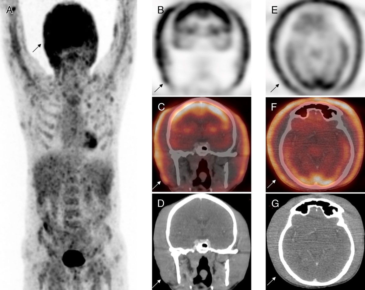ClinNuclearMed's tweet photo. Current Issue: “Hood Sign” in Nuclear Medicine: An Unusual Presentation of Mantle Cell Lymphoma as Detected on FDG PET/CT https://t.co/7SDRNEdUYE https://t.co/AAjCyDs9fY