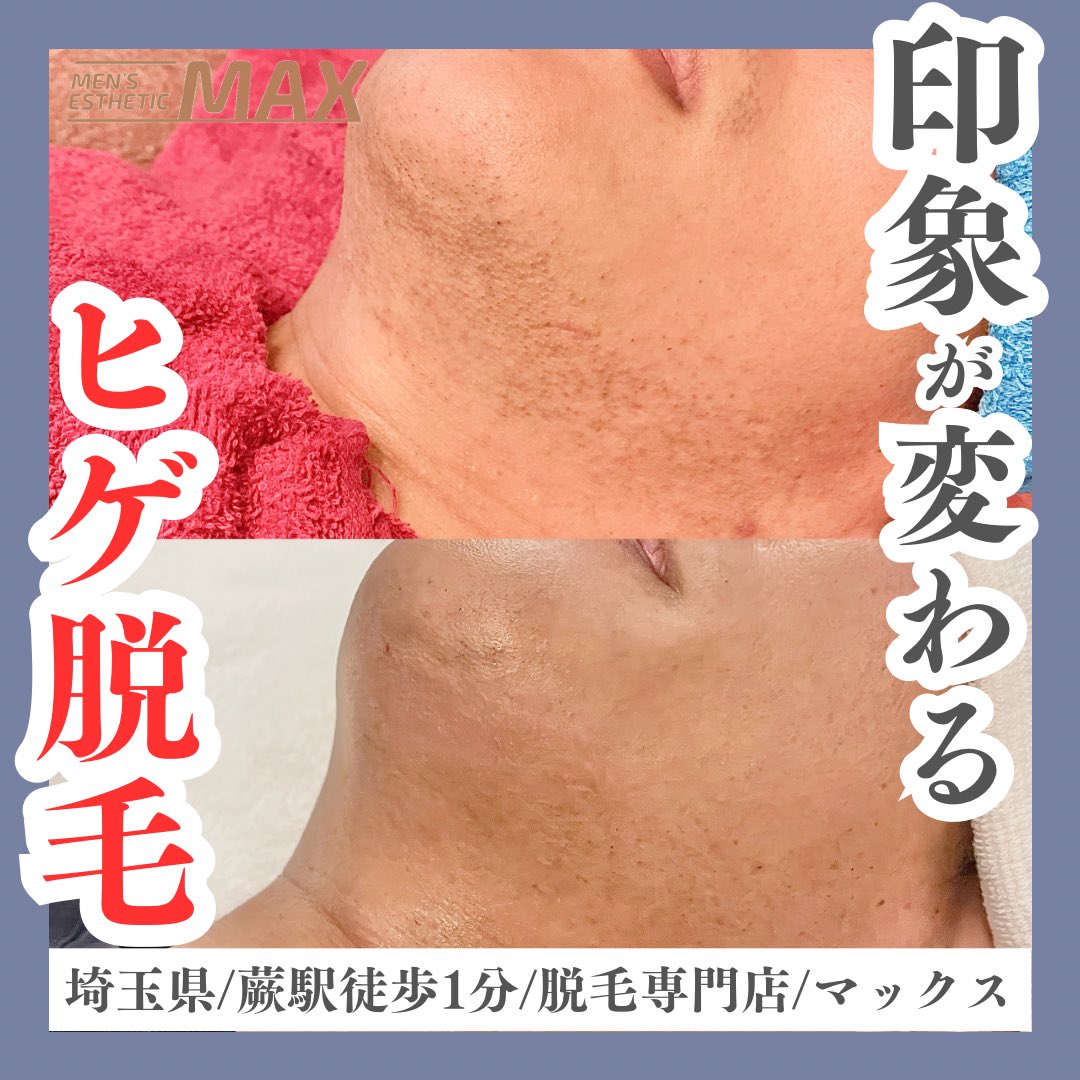 max_warabi02's tweet photo. 先日の事件であまり良くない意味で有名になった"蕨"ですが…

私は引っ越してきてから
蕨の脱毛サロンの店長になってから
丸1年経ちました🚚💨

美味しいご飯屋さんもいっぱいあるし
お祭り等の行事がいっぱいあって
そして素敵なお客様に出会えて
とても良いところです☺️✨✨

"日本一小さい市"ですが https://t.co/BrcwaQfpvT