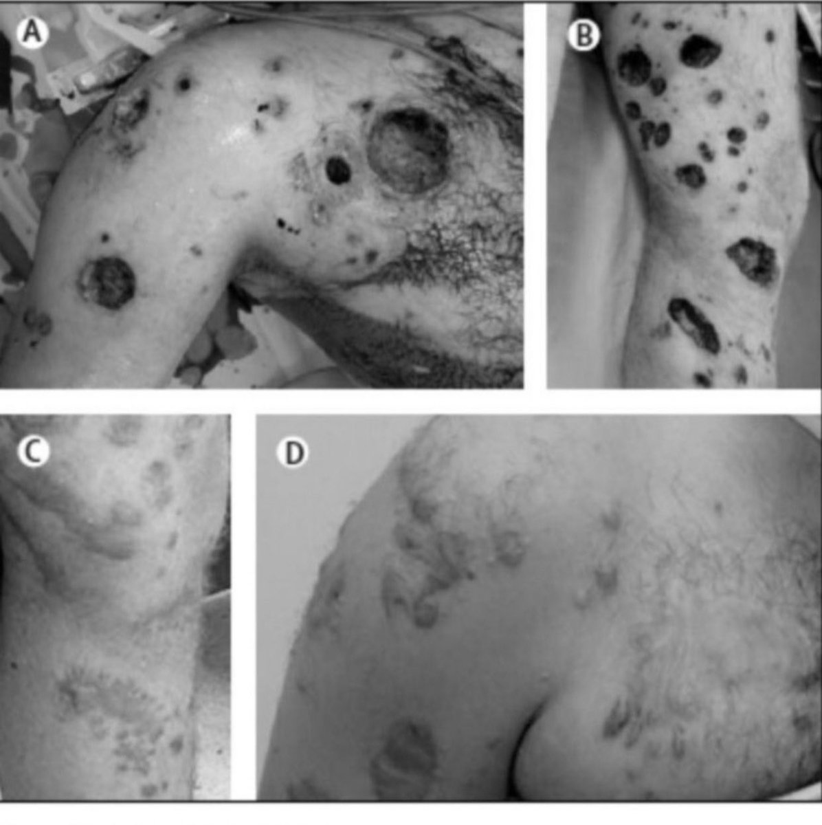 zahadeeler's tweet photo. Israel targets UNRWA schools with phosphorus bombs prohibited in international law. It is mentioned that Israel used the same weapon when it bombed Gaza in 2014, the picture shows the effects of phosphorus on Palestinian bodies in 2014.
#GazaGenoside #INDvsSL https://t.co/PwEkOsJ1nW