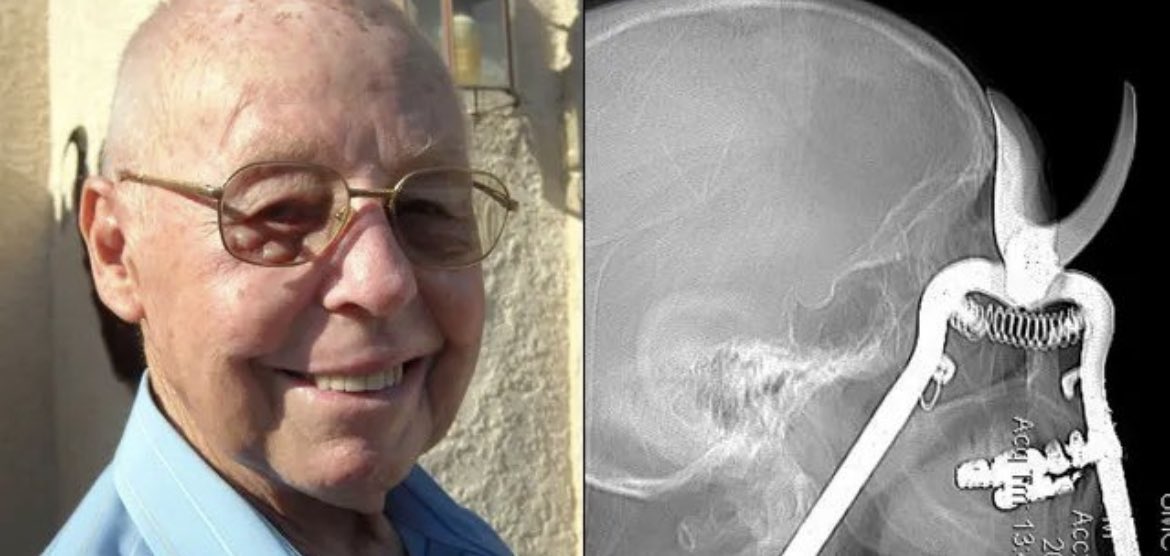 In 2011, Leroy Luetscher, 86, had finished trimming plants outside his home in Phoenix, Arizona, when he dropped the shears.

As he bent down to pick them up he lost his balance and fell face down directly on to the handle of the shears which penetrated his eye socket and went