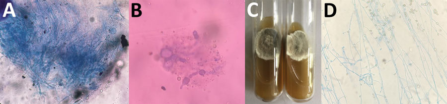 #Scedosporium infection in recipients of #kidney transplants from deceased near-drowning donor, EID journal, bit.ly/45KbDA5 (Authors: Devprakash Choudhary, @HarsimranPGI)