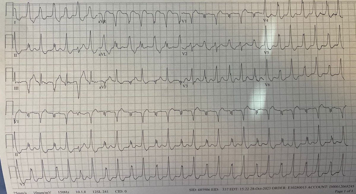 Rhythm? Ddx? #EPeeps @ecgandrhythmRoe @ecgrhythms @Arron_Pearce_ @The_Nanashi_O @PacingSpike @DidlakeDW