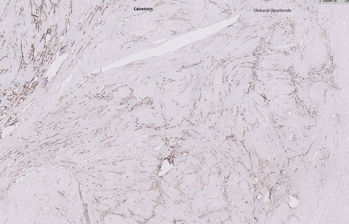 bjbanji's tweet photo. Heavy menses in a middle aged woman!
🔹Uterus
Well circumscribed neoplasm composed of mesothelial lined vascular-like spaces .
🔹CK+, CK5/6+, Calretinin +, CD34 -
✔️Adenomatoid tumour
#GeneralPathology #GynPath #PathTwitter #PathX https://t.co/J3XN9WBWrl
