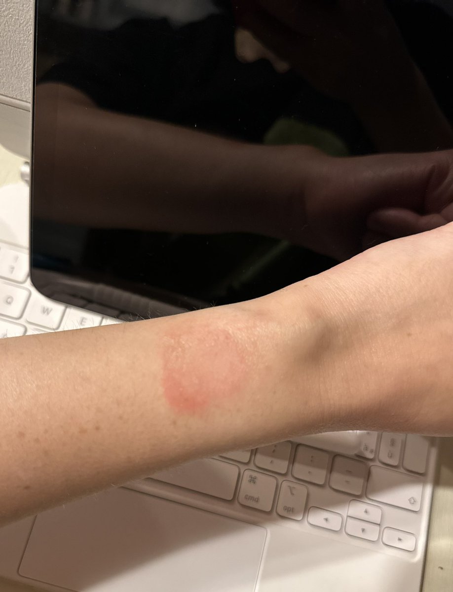 PinnaMartina's tweet photo. È normale che l’Apple orologio mi faccia questo sfogo sul polso? Lo sto mettendo sul destro e sta iniziando anche lì.
@CaraCori ci sono gli estremi per una causa con percentuale?
Ragazzi a me pare strano, ditemi se a qualcuno è successo https://t.co/pML6bPDL5u