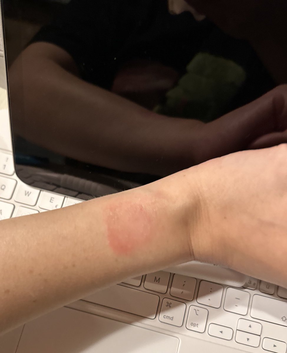 PinnaMartina's tweet photo. È normale che l’Apple orologio mi faccia questo sfogo sul polso? Lo sto mettendo sul destro e sta iniziando anche lì.
@CaraCori ci sono gli estremi per una causa con percentuale?
Ragazzi a me pare strano, ditemi se a qualcuno è successo https://t.co/pML6bPDL5u