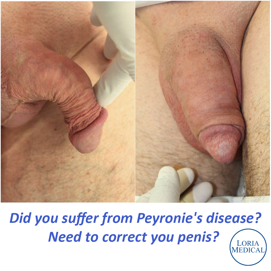 DrVictorLoria's tweet photo. We can help you with the shape of your penis after a Peyronie's desease treatment #maleenhancement #penisenlargement #plasticsurgery #Miami #DrLoria #permanentfiller #MiaKhalifa #miamiheat #TexasRangers #MLB #Superman #MiamiDolphins https://t.co/MNf1baJ5GX