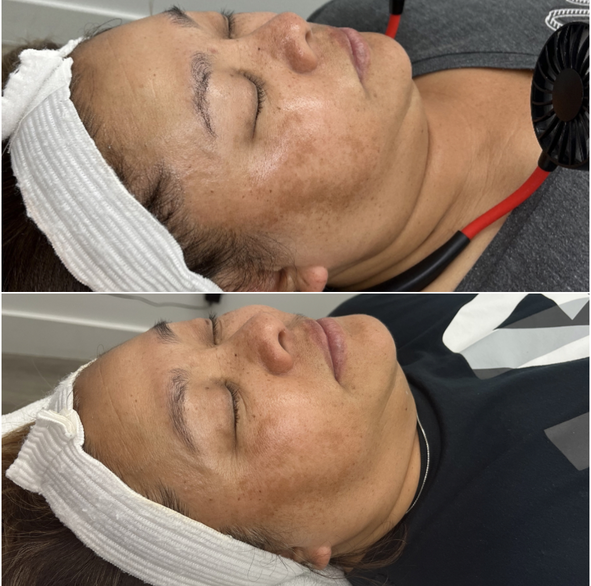 foreverbyash's tweet photo. Results from just 2 melasma peels 😍  the discoloration has significantly decreased! We can’t wait to see the final outcome #peels #chemicalpeel #utahskintreatment #utahskin #skintreatment #skin #skinlightening https://t.co/bKALC6OIUx