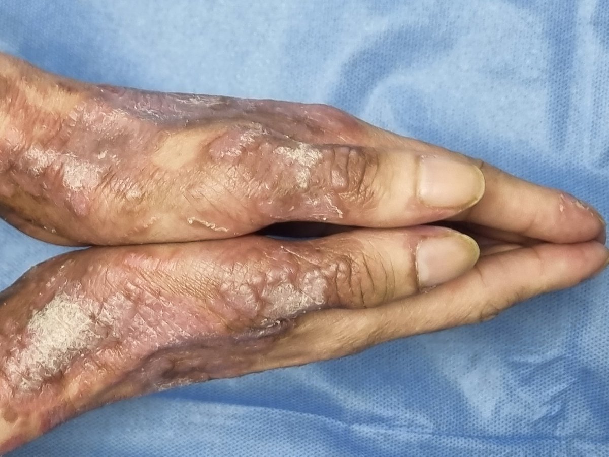 drdanielderma's tweet photo. 22-year-old patient, B24X, mucocutaneous and gastrointestinal kaposi sarcoma treated with doxorubicin, 3 months with these lesions in hands and feet.  Share the diagnostic possibilities of this patient in our post. 👇🏻 #skin #dermatologie #dermatologue #dermatologo #dermatologist https://t.co/nBbBqGYMy7