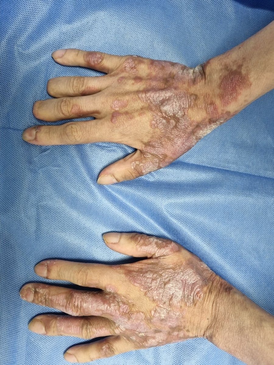 drdanielderma's tweet photo. 22-year-old patient, B24X, mucocutaneous and gastrointestinal kaposi sarcoma treated with doxorubicin, 3 months with these lesions in hands and feet.  Share the diagnostic possibilities of this patient in our post. 👇🏻 #skin #dermatologie #dermatologue #dermatologo #dermatologist https://t.co/nBbBqGYMy7
