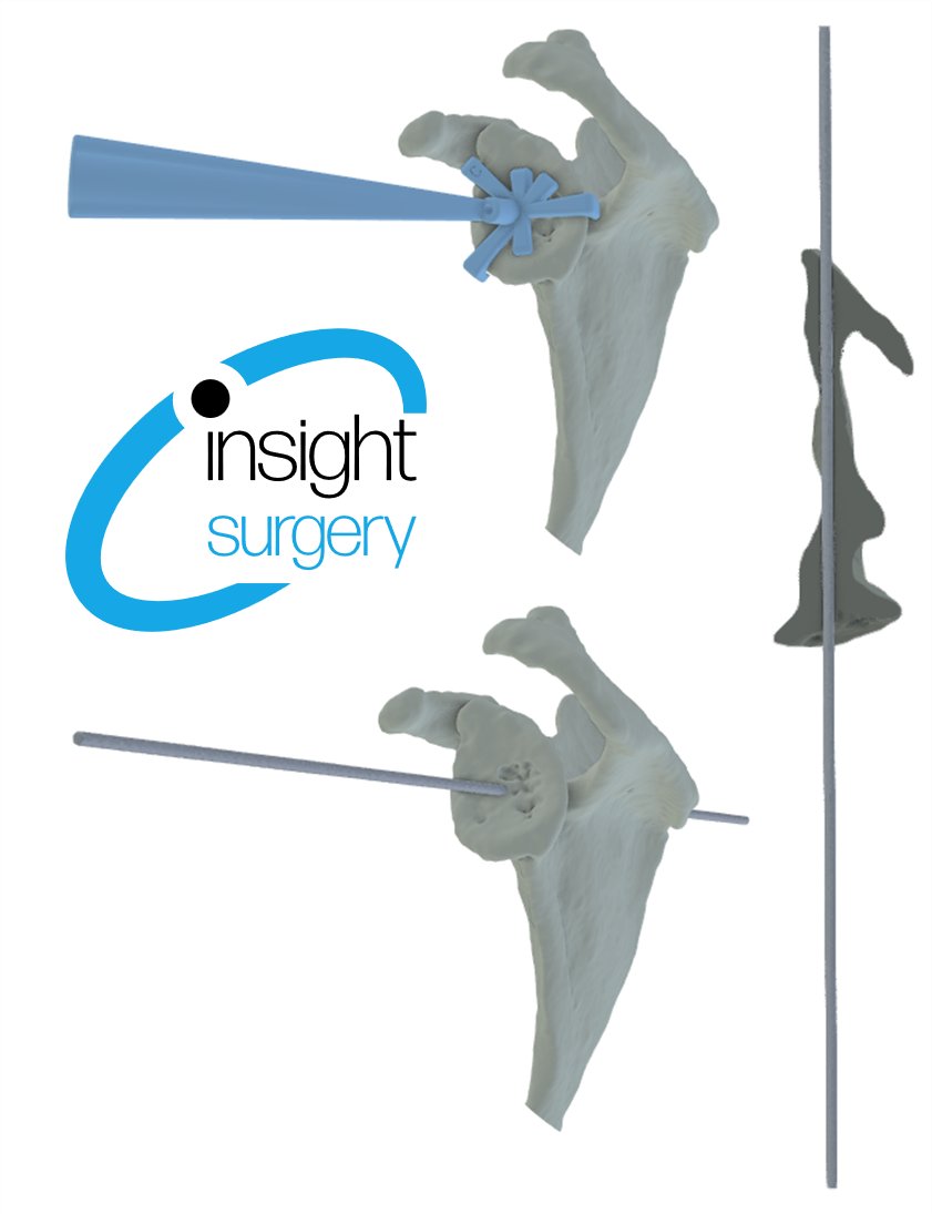 Precision in shoulder arthroplasty!
Another successful case completed by Prof Trail at <a href="/wrightington16/">Wrightington Hospital</a> using the Wrightington Glenoid 
Guide produced by Insight Surgery.
Enabling highly accurate location of the axis for primary arthroplasty even when dealing with complex anatomy