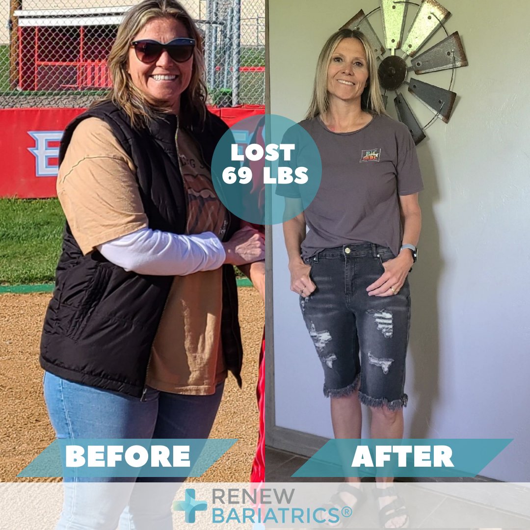 Marilyn Gibson's One-Year Surgiversary! 🎉

From 195lbs to 126lbs, her journey is truly remarkable. With a goal of 130lbs, the surgery brought boundless energy.  Her only regret? Not doing it sooner. 🌟 #WeightLossSuccess #TransformationJourney #LifeChangingSurgery #Surgiversary