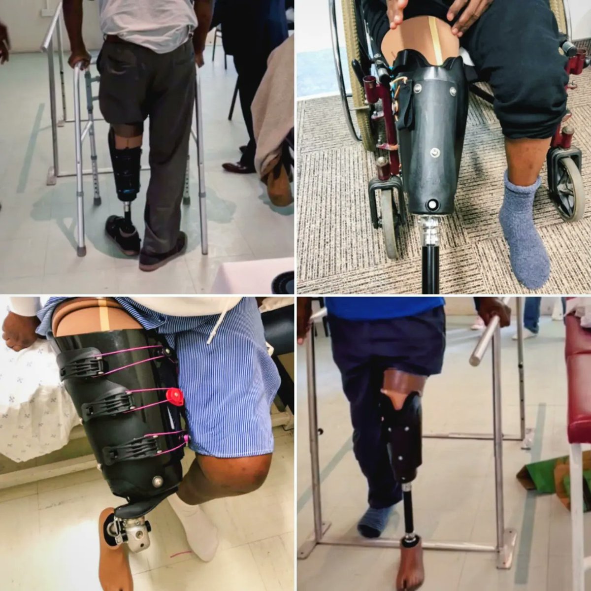 pennpmr's tweet image. Botswana-UPenn Partnership update:

Over the summer, Dr. Dillingham and his team worked with local prosthetists and therapists across 3 sites in Botswana to fit 16 patients in 7 days with the newest iFit System!

#prosthetics #prosthesis #botswana
